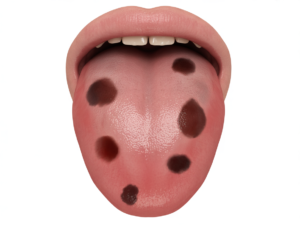 Tongue Has Dark Spots