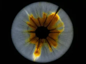 dark spot on retinal image