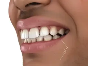 how to get rid of dark spots on gums 