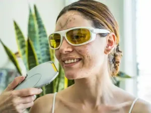 laser treatment to remove dark spots on face