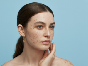 Laser Dark Spot Removal Near Me