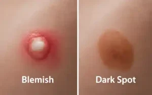 blemish vs dark spot