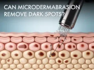  can microdermabrasion remove dark spots effectively
