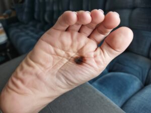 dark spot on my foot
