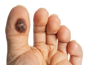 dark spot on toe skin