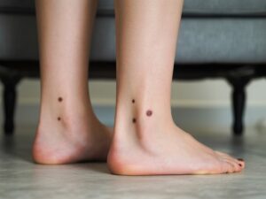 dark spots on ankles