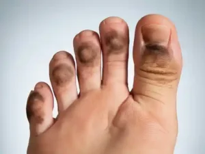 dark spots on toes from shoes