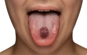 darker spot on your tongue