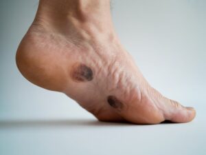 hard dark spots on bottom of feet