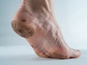 how to get rid of dark spots in bikini area